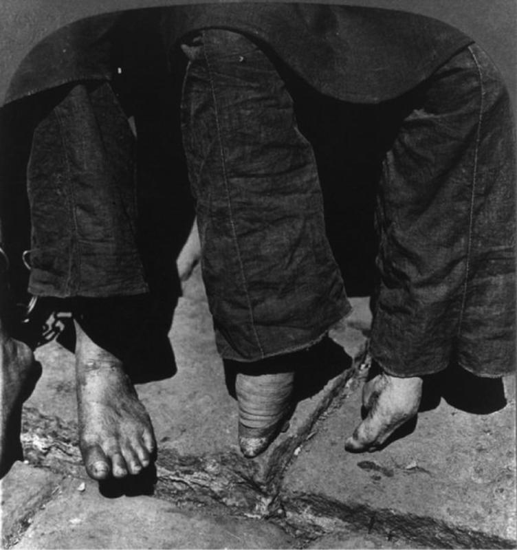 Chinese Women With Bound Feet 29