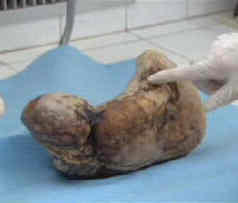 calcified fetus