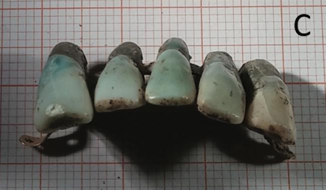dentures-1